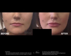 Lip Volume Treatment BA Image