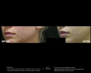 Lip Volume Treatment BA Image