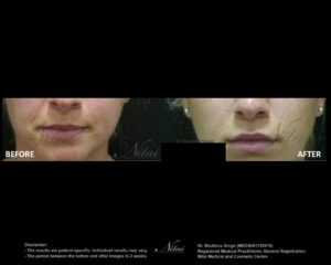 Lip Volume Treatment BA Image
