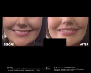 Lip Volume Treatment BA Image