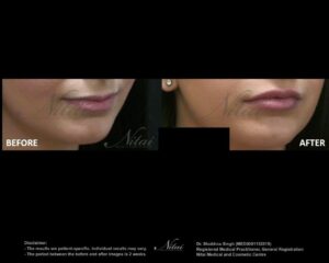 Lip Volume Treatment BA Image