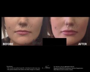 Lip Volume Treatment BA Image