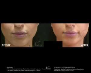 Lip Volume Treatment BA Image