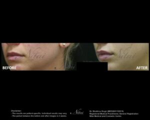 Lip Volume Treatment BA Image