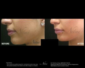 Lip Volume Treatment BA Image
