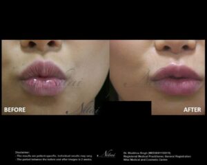 Lip Volume Treatment BA Image