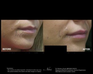Lip Volume Treatment BA Image