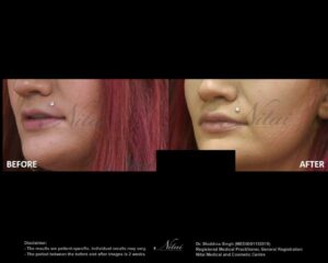 Lip Volume Treatment BA Image