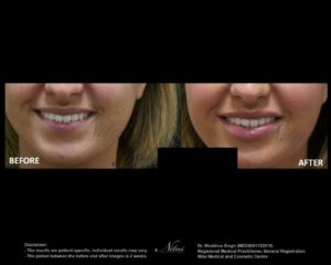 Lip Volume Treatment BA Image