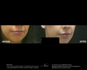 Lip Volume Treatment BA Image