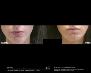 Lip Volume Treatment BA Image
