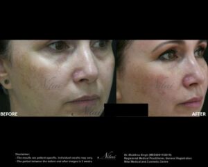 Lip Volume Treatment BA Image