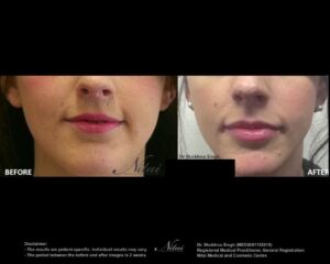 Lip Volume Treatment BA Image