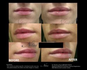 Lip Volume Treatment BA Image