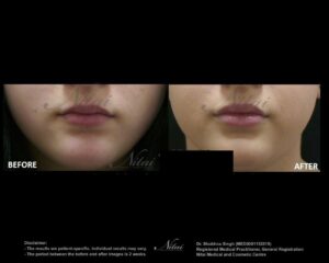 Lip Volume Treatment BA Image