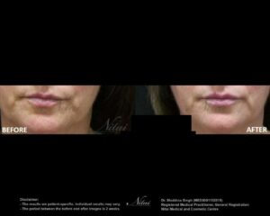 Lip Volume Treatment BA Image
