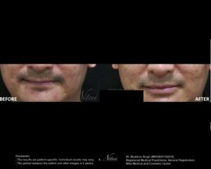 Lip Volume Treatment BA Image