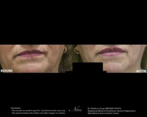 Lip Volume Treatment BA Image