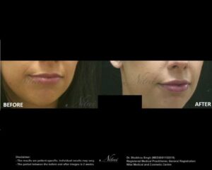 Lip Volume Treatment BA Image