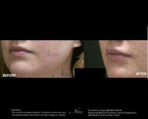 Lip Volume Treatment BA Image