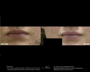 Lip Volume Treatment BA Image