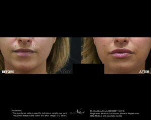 Lip Volume Treatment BA Image