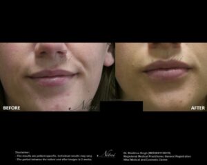 Lip Volume Treatment BA Image