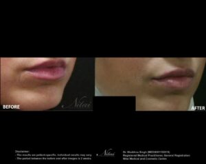 Lip Volume Treatment BA Image