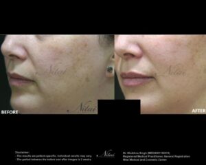 Lip Volume Treatment BA Image
