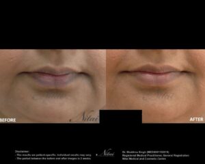 Lip Volume Treatment BA Image