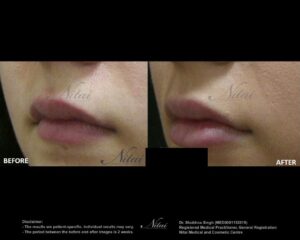 Lip Volume Treatment BA Image