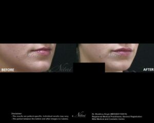 Lip Volume Treatment BA Image