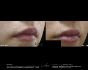 Lip Volume Treatment BA Image