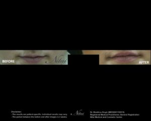 Lip Volume Treatment BA Image