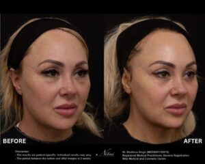 Dermal Treatment BA Image