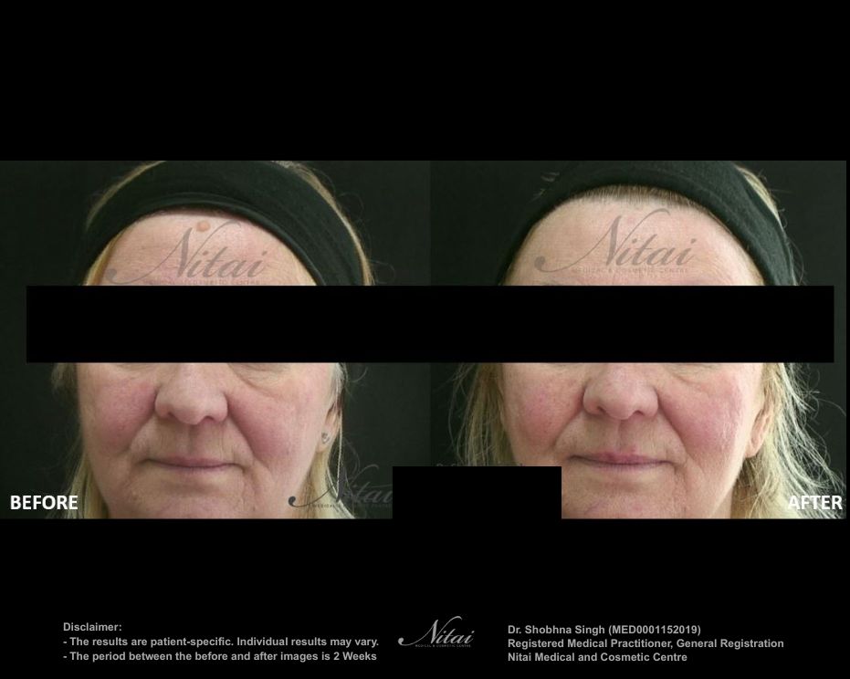 Moles Skin tags Birthmarks BA Images
