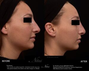 PDO Thread Treatment BA Image