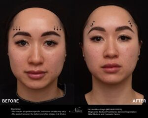 PDO Thread Treatment BA Image