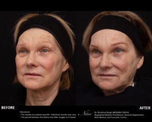 Anti-Wrinkle Treatment BA Image