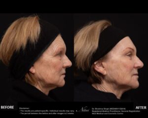 Anti-Wrinkle Treatment BA Image