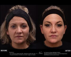 Anti-Wrinkle Treatment BA Image
