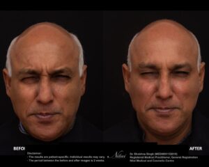 Anti-Wrinkle Treatment BA Image