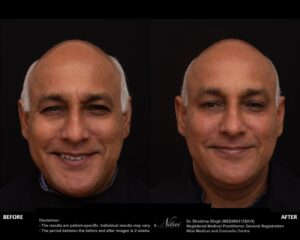 Anti-Wrinkle Treatment BA Image