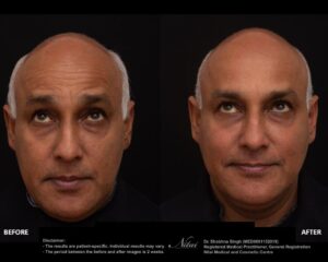 Anti-Wrinkle Treatment BA Image