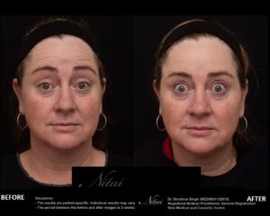 Anti-Wrinkle Treatment BA Image