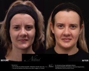 Anti-Wrinkle Treatment BA Image
