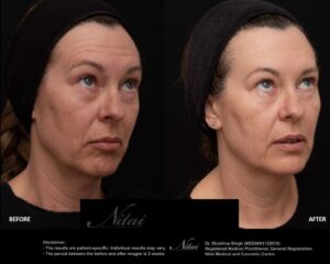 Anti-Wrinkle Treatment BA Image