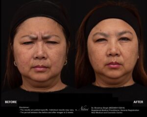 Anti-Wrinkle Treatment BA Image