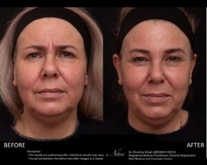 Anti-Wrinkle Treatment BA Image