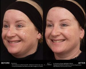 Anti-Wrinkle Treatment BA Image
